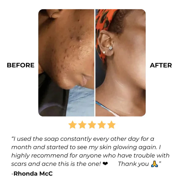 EarthGlow Anti-Acne & Dark Spots African Soap