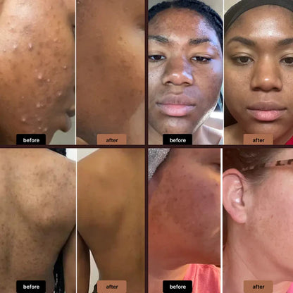 EarthGlow Anti-Acne & Dark Spots African Soap