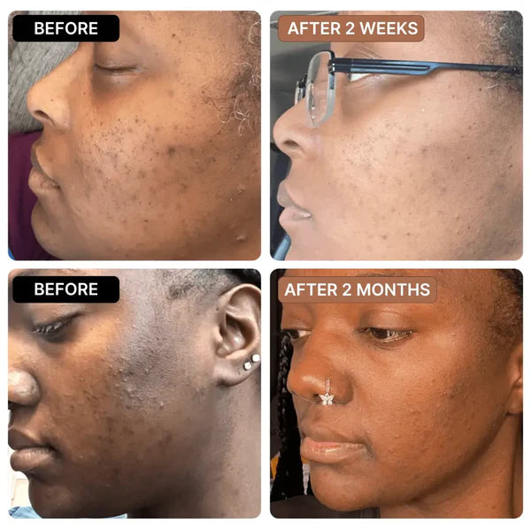 EarthGlow Anti-Acne & Dark Spots African Soap